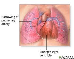 pulmonary artery hypr