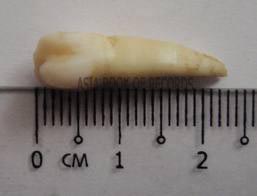 LONGEST HUMAN TOOTH EXTRACTED